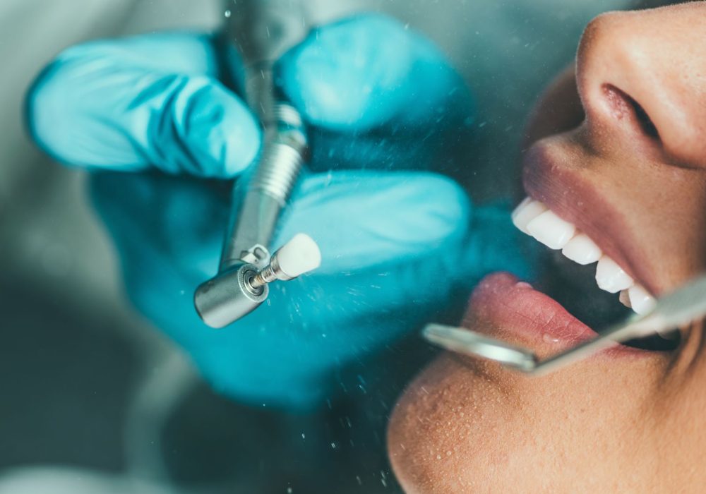 Teeth Polishing